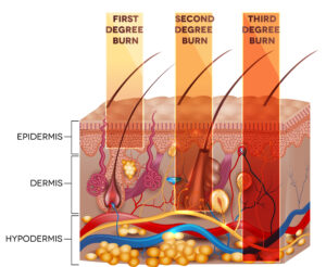 Medical illustration of fire pit burn injuries showing first, second, and third-degree burns from alcohol fuel explosions